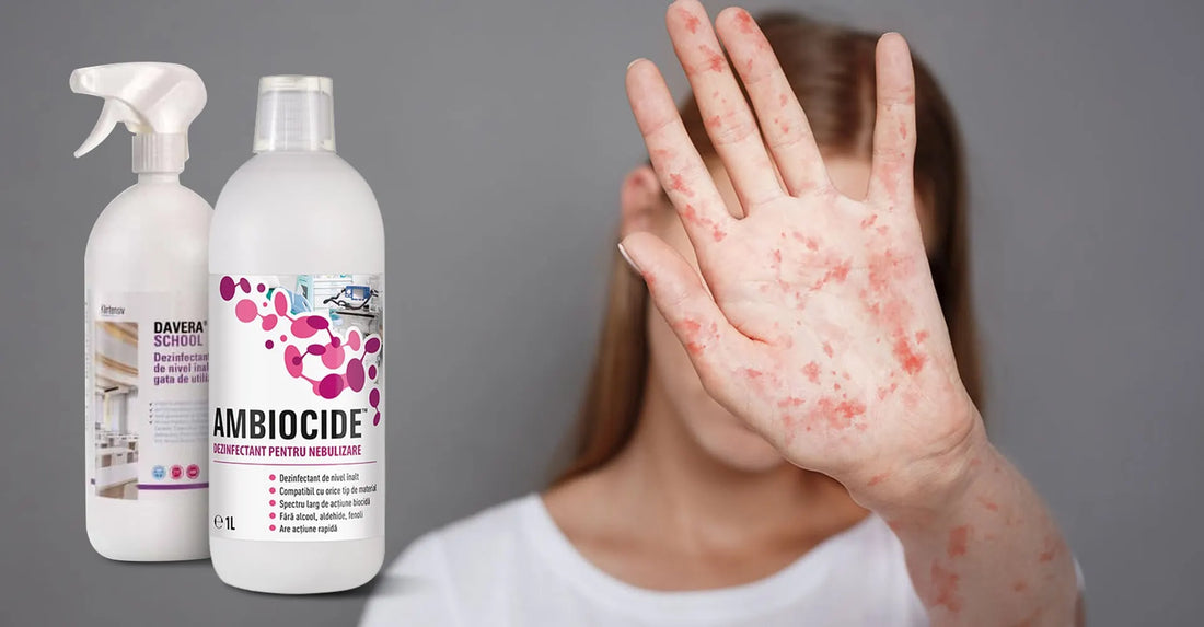 Varicela si pojar, care este diferenta dintre ele?